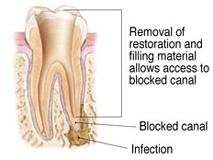 Endodontic surgery can be used to locate small fractures or hidden canals that weren't detected on x-rays